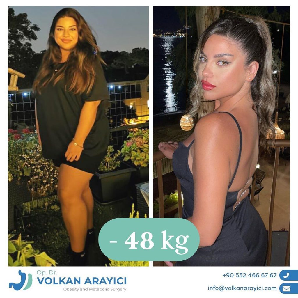 Magenverkleinerung: Was sind die finanziellen Aspekte der Behandlung?